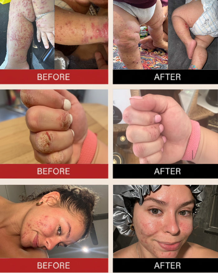 Eczema less® Cream - Soothing Cream | ALOE ACTIVE™